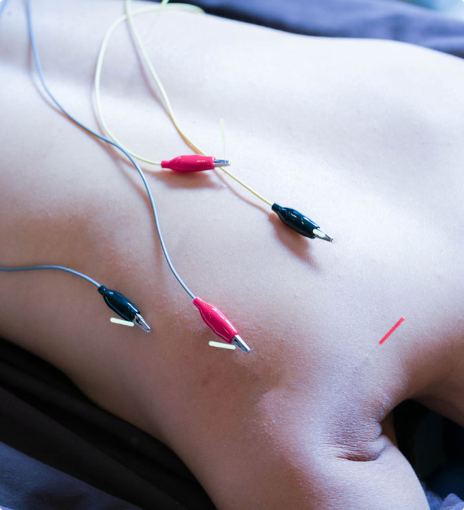 electroacupuncture on a persons back