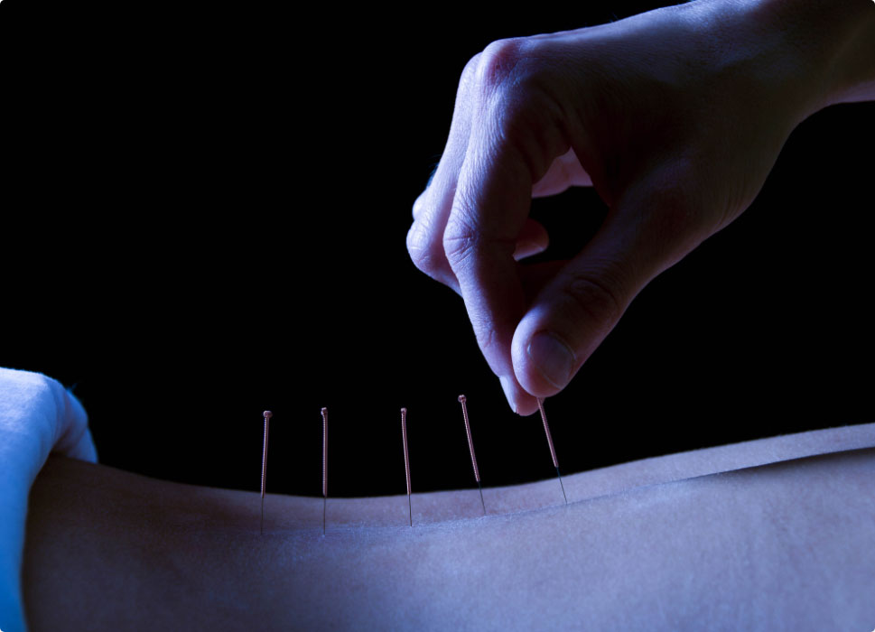 Austin Acupuncture Dry Needling Therapy Deep Relief