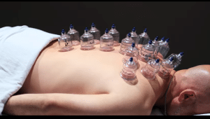 Cupping Therapy